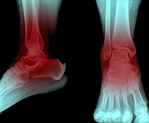 Gout Model | Gout Patient Education Models | GPI Anatomicals