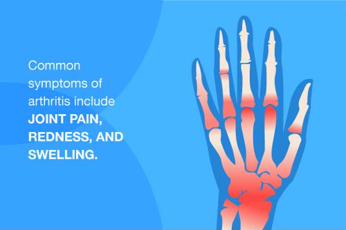 Illustration of hand bones showing where arthritis may strike.